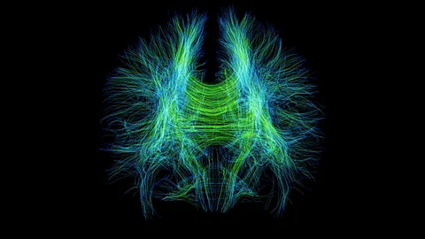 Brain fibres, as seen in this MRI scan, could leave physical clues of depression (Science Photo Library)