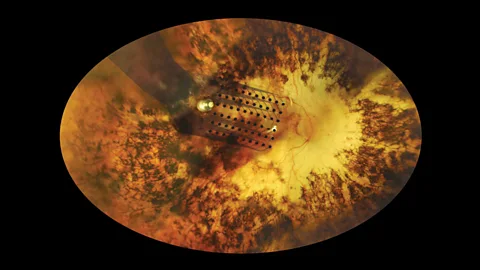 An implanted electrode on the retina bypasses the failed parts of the eye (Second Site)