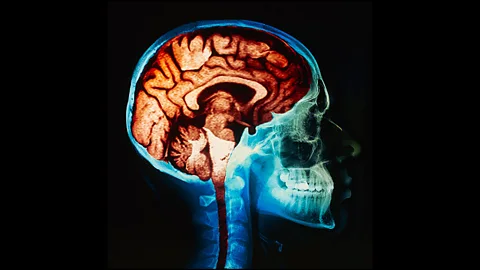 The brains of ultra-athletes shrink significantly during events (SPL)