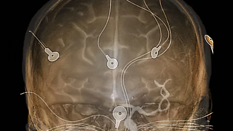 SPL A CT scan of the brain, also featuring the electrodes used for electroencephalography (Credit: SPL)