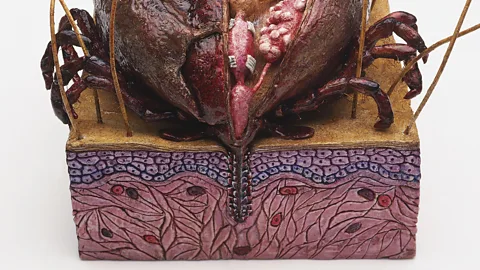 Science Photo Library When the tick is squeezed, it injects more of its saliva and stomach contents into the bite – so they are best removed by freezing (Credit: Science Photo Library)