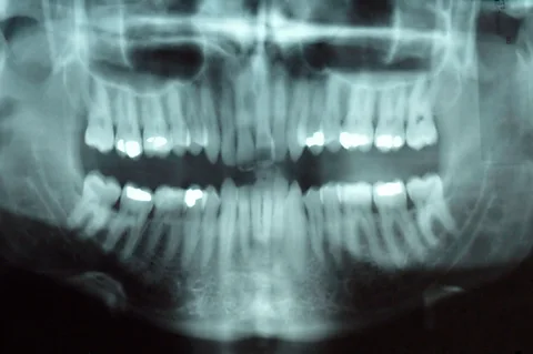 Alamy An electric current may be able to stimulate the creation of enamel, healing tooth decay (Credit: Alamy)