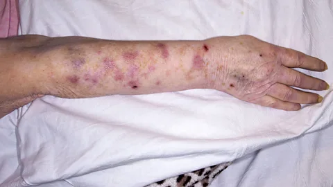Mid Essex Hospital Services NHS Trust/Science Photo Library The burning pain that occurs with an outbreak of shingles can be unbearable (Credit: Mid Essex Hospital Services NHS Trust/Science Photo Library)