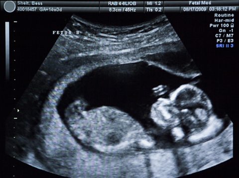 Fetal ultrasound at 14 weeks.