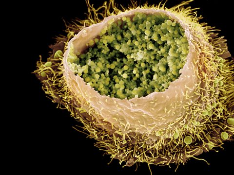 A picture of a human cell infected with chlamydia bacteria. The bacteria are much smaller than the human cell.