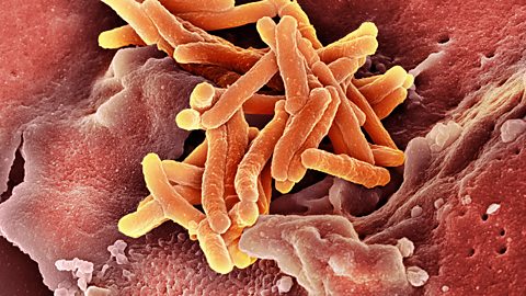 Coloured scanning electron micrograph (SEM) of a macrophage white blood cell engulfing a tuberculosis (Mycobacterium tuberculosis) bacterium (orange).