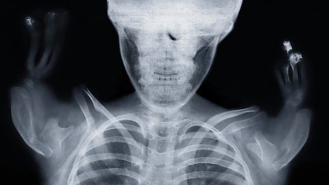 An X-ray of a child affected by thalidomide