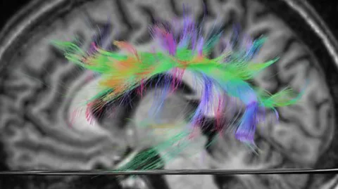 Alamy An MRI scan highlighting the language tract in the brain (Credit: Alamy)