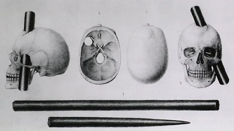Alamy An iron rod blasted through Phineas Gage's brain (Credit: Alamy)