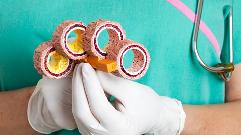 A doctor holding a model of clogged arteries