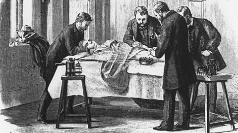 Early surgery, circa 1870 - a cloth covered in chloroform is being held over a patient's face and carbolic spray worked by a steam apparatus is creating an antiseptic atmosphere.