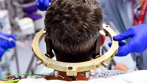 Science Photo Library Deep brain stimulation helps individuals with tremor disorders (Credit: Science Photo Library)