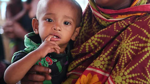 Getty images A new form of therapy that targets the gut microbiome could reduce the long-term effects of malnutrition (Credit: Getty images)