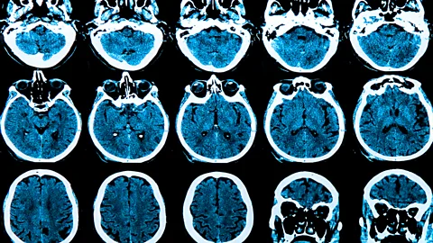 Getty Images The signs of alzheimer's disease can be spotted in brain scans by artificial intelligence years before diagnosis (Credit: Getty Images)