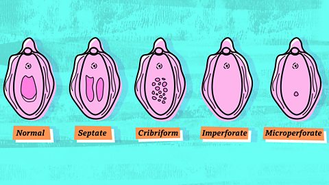 Hymen Abnormalities Using My First Tampon Put Me In A E Bbc Three