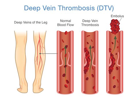 A medical diagram of deep vein thrombosis