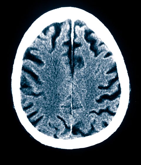 CT scan of an 84 year old man with Alzheimer's disease showing brain atrophy