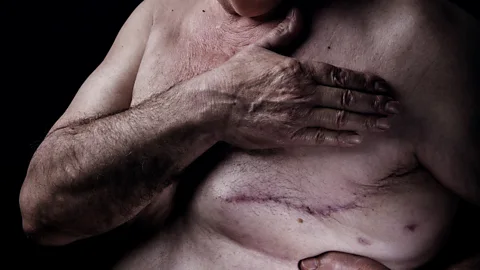 Getty Images A man with a scar after breast cancer surgery (Credit: Getty Images)