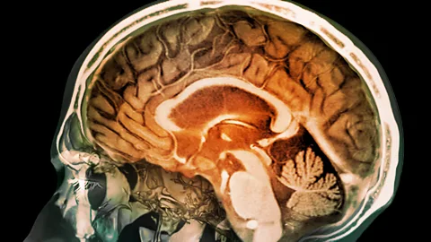 Science Media Library Our brains are delicate organs that are kept safe by our hard skulls, but sometimes they need some extra protection (Credit: Science Media Library)