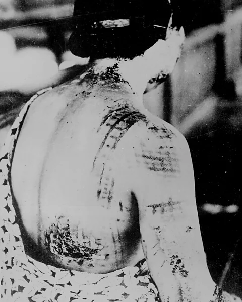 PD At least 200,000 were killed and many tens of thousands of people were injured with burns and worse (Credit: PD)