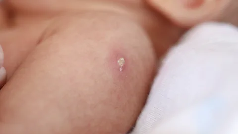 Getty Images The BCG jab, which many of us get in the first few months of life, essentially upgrades the human immune system (Credit: Getty Images)