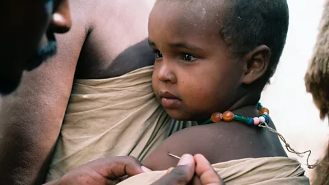 Alamy A global vaccination programme pushed smallpox into extinction in the wild, although the virus still exists in two secure laboratories (Credit: Alamy)