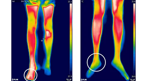 P. Sabitha et al/Plos Neglected Tropical Diseases Inflammation caused by snake venom in a bite glows as hot spots on an infrared camera (left) compared to those without venom (Credit: P. Sabitha et al/Plos NTD)