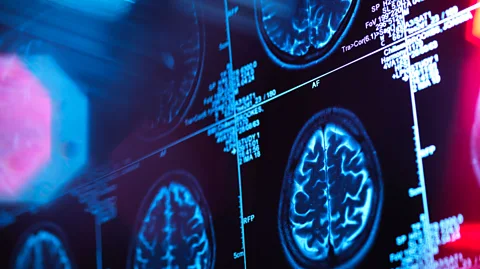 Getty Images Amyloid beta can act as a kind of microbicide that fights pathogens in the brain (Credit: Getty Images)