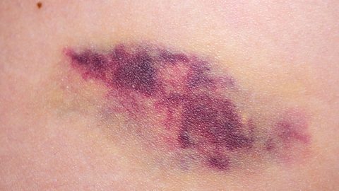 A photo showing a big purple bruise