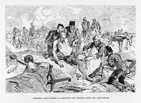 An illustration showing French surgeon, Ambroise Paré, operating on a battlefield. 