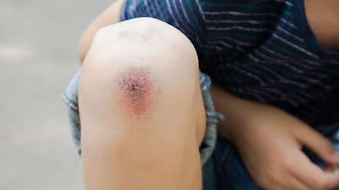 A grazed knee