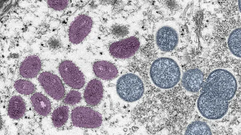 Getty Images The mature mpox virus – shown on the left in his image – is a brick-shaped envelope of genetic material, an oily membrane and proteins (Credit: Getty Images)