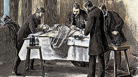 An illustration showing Lister and 3 male assistants performing surgery on a patient with a carbolic acid spray