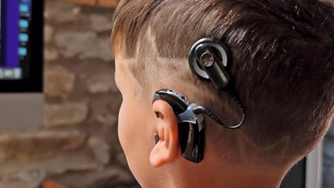 A child with a cochlear implant.