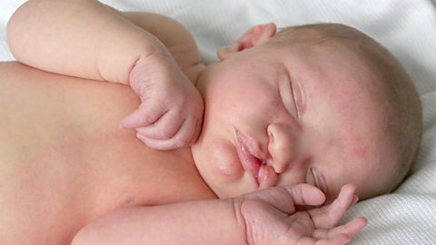 A newborn with a cleft lip