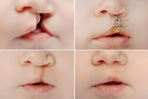 4 images showing stages of healing from cleft palate surgery. One shows the cleft, the second as it's just been stitched, the third is the scar when fresh and the 4th is fully healed.