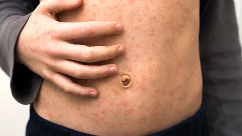 Getty Images One to three of every 1,000 children infected with measles dies, per the CDC (Credit: Getty Images)