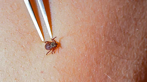 Alamy Tick being removed with tweezers (Credit: Alamy)