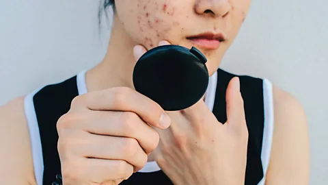 Getty Images Severe acne in adolescents is much more likely to be the result of genetics than diet, experts suggest (Credit: Getty Images)