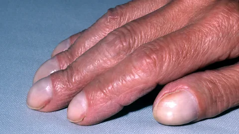 Alamy Clubbed nails are shaped like an upside down spoon, and can be an indicator of a serious underlying condition such as lung cancer (Credit: Alamy)