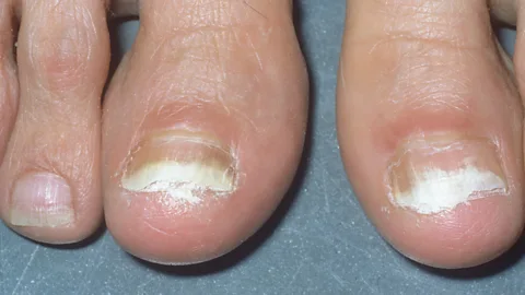 Getty Images Fungal nail infections can take up to a year to treat successfully (Credit: Getty Images)