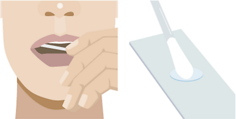 A hand swabbing cells from the inside of a cheek, and placing it on a glass slide.