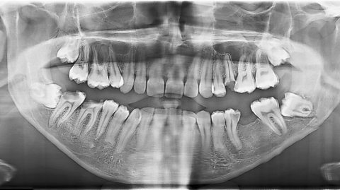 Dental panoramic x-ray showing impacted lower wisdom teeth