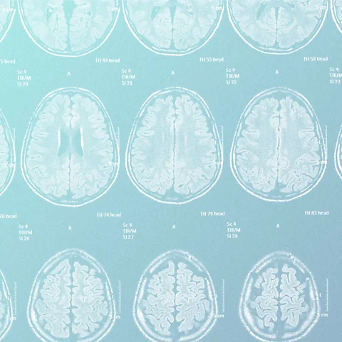 Serenity Strull/ Getty Images Better understanding of the basic science of migraines could one day inform better treatments (Credit: Serenity Strull/ Getty Images)