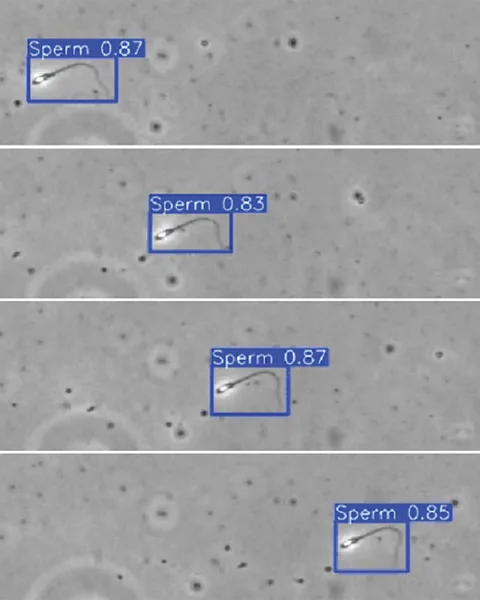 Columbia University Fertility Center Detecting single sperm cells from azoospermic men is a challenge, but the AI can screen them rapidly (Credit: Columbia University Fertility Center)