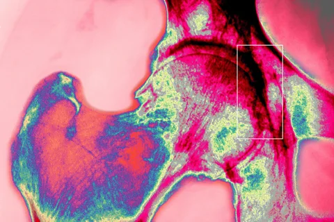 Getty Images A coloured x-ray of a right hip joint shaded red where chronic arthritis has damaged the bone (Credit: Getty Images)