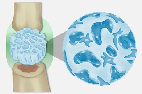 Xiao-Hua Qin/ ETH Zurich A jelly-like implant with a porous structure would allow bone cells to integrate into its structure and so improve fracture healing (Credit: Xiao-Hua Qin/ ETH Zurich)