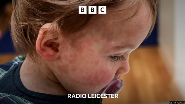 BBC Radio Leicester - Leicester, Rising Number Of Measles Cases In ...