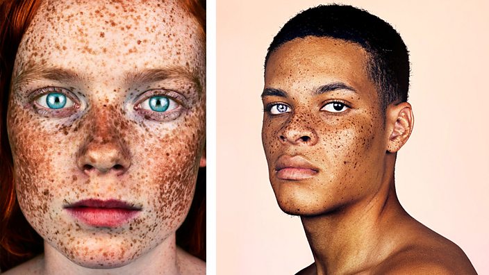 freckles all over body