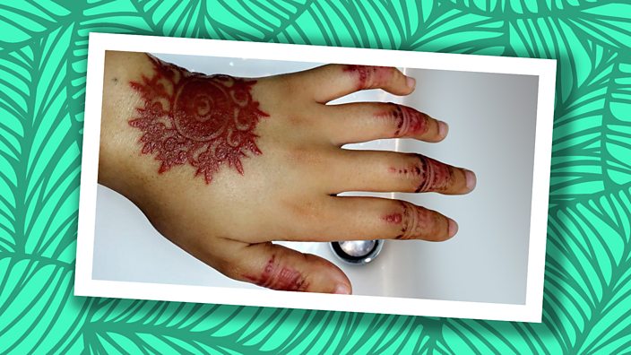 Black henna scarring on a woman's hand